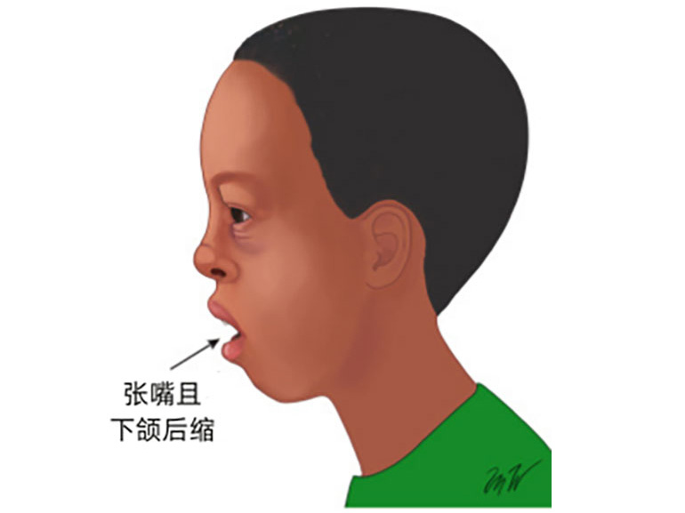 Renowned doctor Shi Jianbo from Zhongda visited our hospital to help a 3-year-old child bid farewell to adenoid hypertrophy