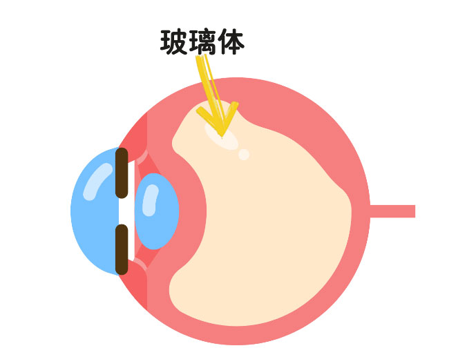 視物模糊、眼前黑影、看東西變形？玻璃體注藥助力黃斑變性患者改善症狀
