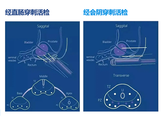拜登確診前列腺癌！威脅中老年男性“生命腺”的沉默殺手，該如何早發現早治療？