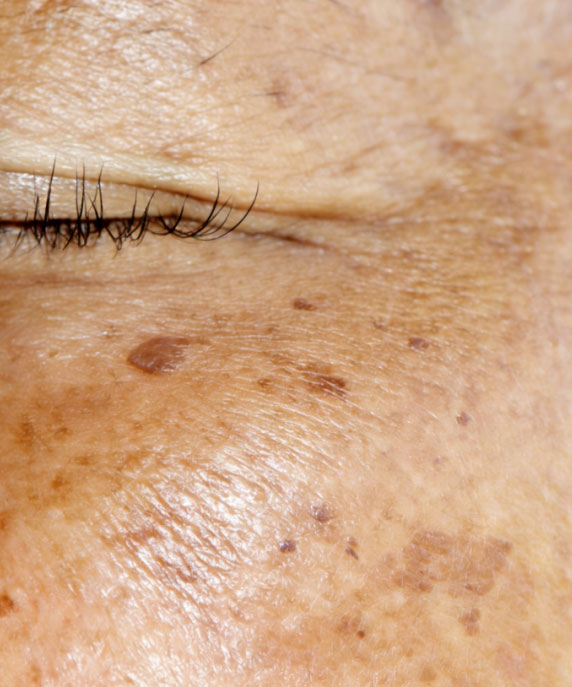 面部常見的色素斑有哪些？