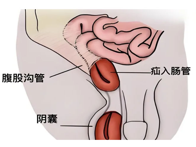 中國每年新發300多萬例！腹股溝那個